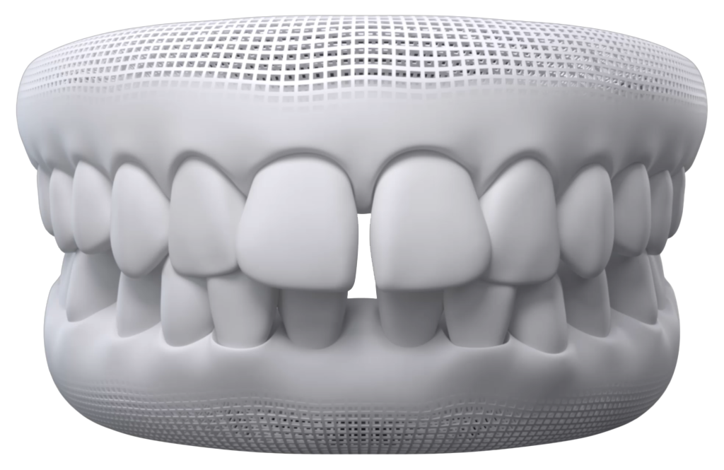 Diastema antes